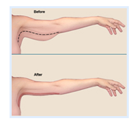 Picture of an arm lift procedure