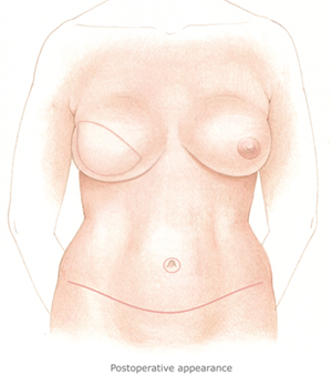 Picture of a breast reconstruction procedure