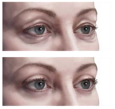 Picture of an eyelid lift procedure
