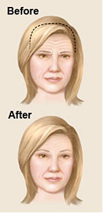 Picture of a forehead lift procedure