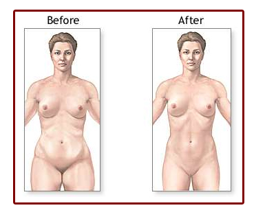 Picture of a woman's before and after liposculpture procedure.