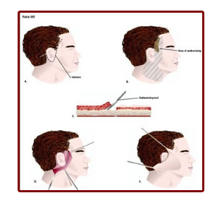 Set with 4 images for male face lifts