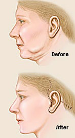 Picture of a neck lift procedure