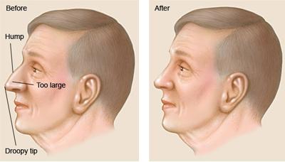 Picture of a nose surgery procedure